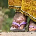 India’s Multi-Pronged Strategy in Fighting Lymphatic Filariasis Gains Momentum