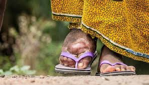 India’s Multi-Pronged Strategy in Fighting Lymphatic Filariasis Gains Momentum