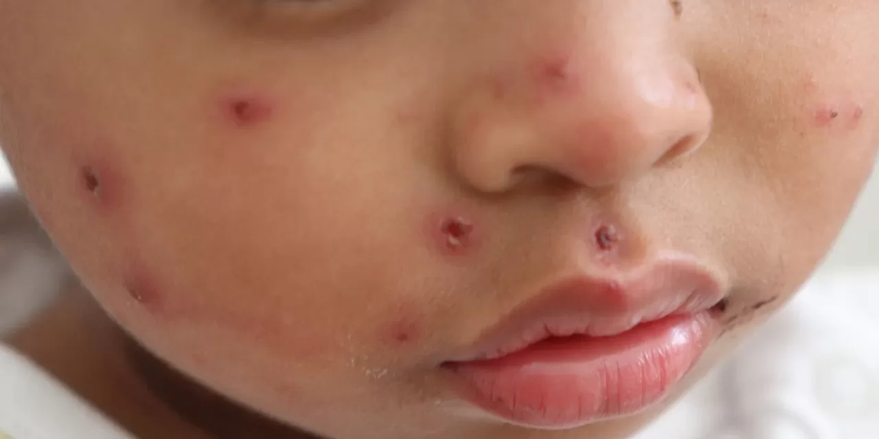 Measles Outbreak Surges in Texas and New Mexico, Nearly 300 Cases Reported