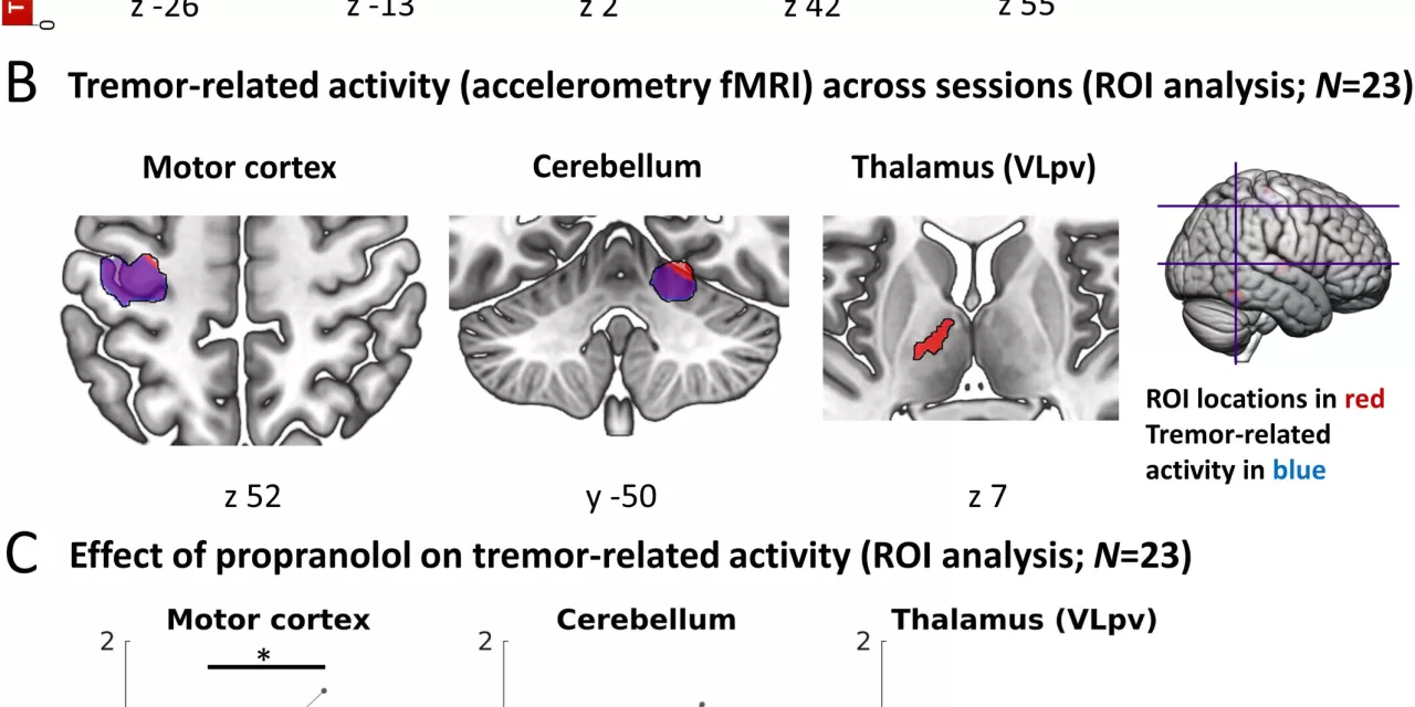 Clinical Trial Shows Propranolol Reduces Tremors in Parkinson’s Disease, Offering Hope for Stress-Induced Symptoms