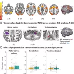 Clinical Trial Shows Propranolol Reduces Tremors in Parkinson’s Disease, Offering Hope for Stress-Induced Symptoms