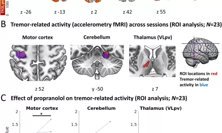 Clinical Trial Shows Propranolol Reduces Tremors in Parkinson’s Disease, Offering Hope for Stress-Induced Symptoms