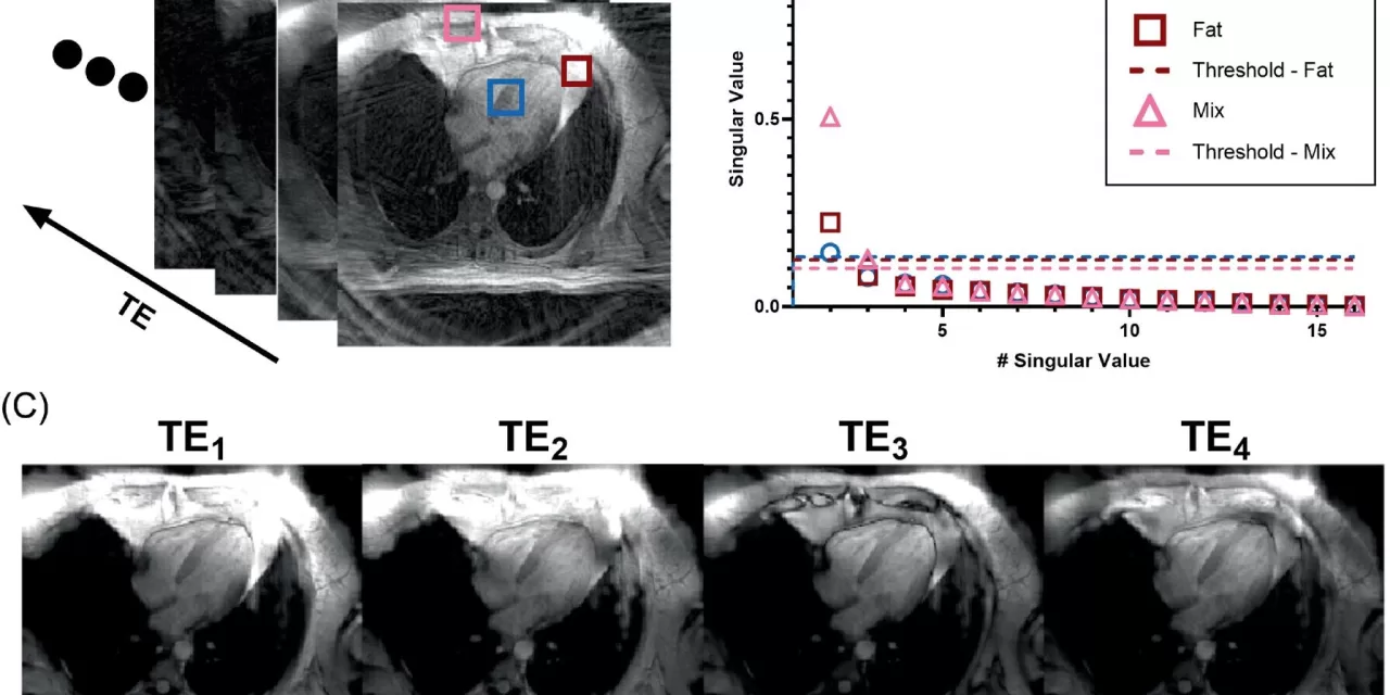 New MRI Technique Identifies Heart Disease Risk from Fat Composition