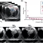 New MRI Technique Identifies Heart Disease Risk from Fat Composition