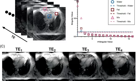 New MRI Technique Identifies Heart Disease Risk from Fat Composition