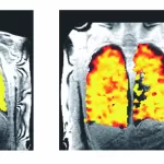 New Lung Scanning Technique Reveals Real-Time Treatment Effects