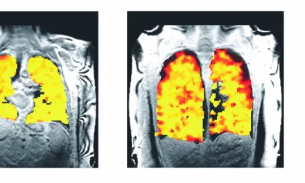 New Lung Scanning Technique Reveals Real-Time Treatment Effects