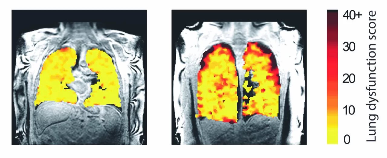 New Lung Scanning Technique Reveals Real-Time Treatment Effects