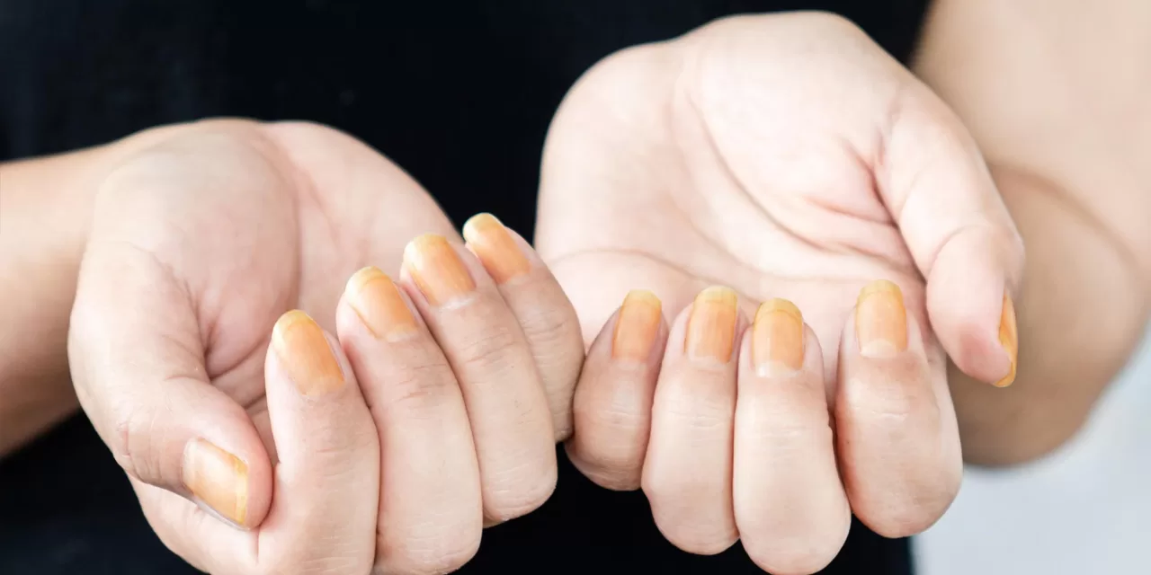 Scientists Discover Key Cause of Yellow Nail Syndrome