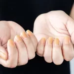 Scientists Discover Key Cause of Yellow Nail Syndrome