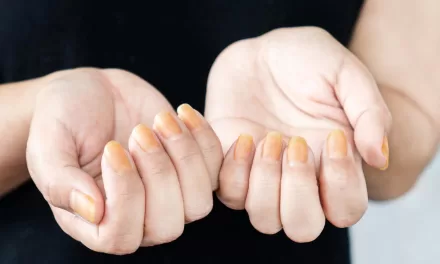 Scientists Discover Key Cause of Yellow Nail Syndrome