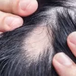 Beyond Hair Loss: Can a Common Baldness Pill Protect Your Heart?