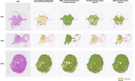 Advancements in AI for Breast Cancer Diagnosis: Abhinav Sharma’s Groundbreaking Thesis on Deep Learning-Based Models