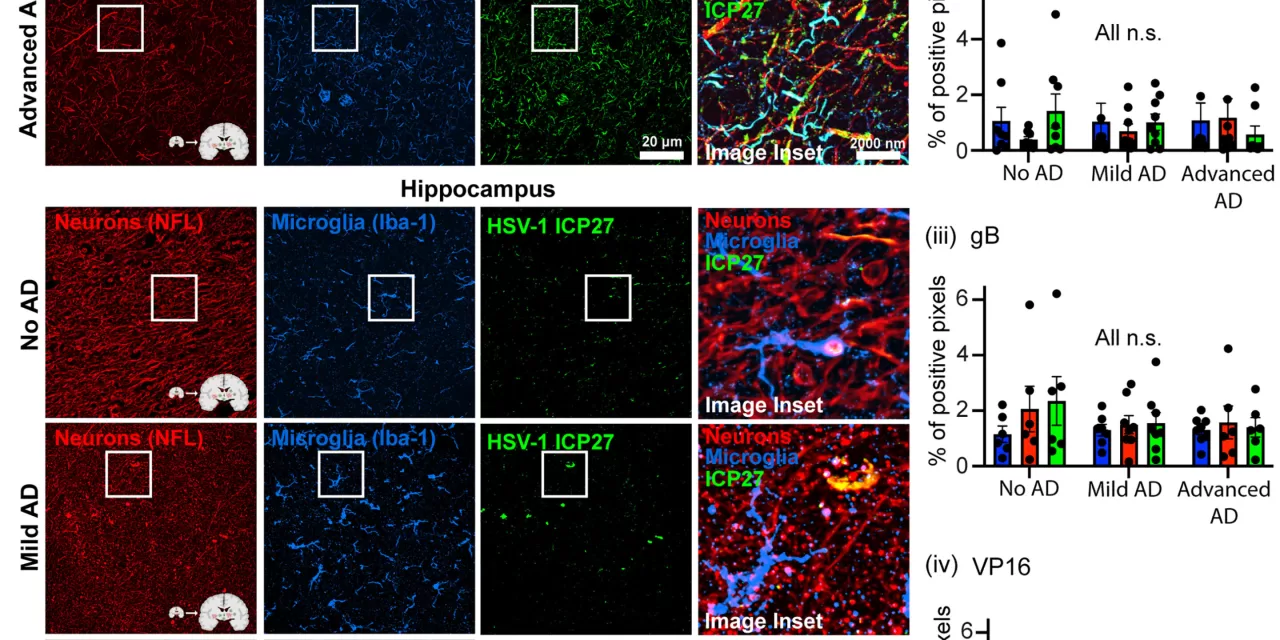 Herpes Virus May Drive Alzheimer’s Pathology, New Study Suggests