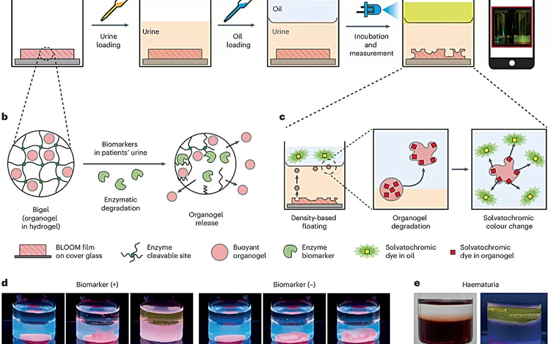 Urine-based bladder cancer diagnostic kit for home use developed