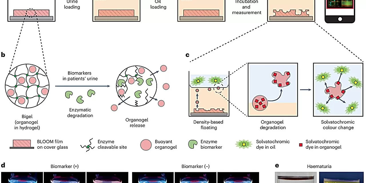 Urine-based bladder cancer diagnostic kit for home use developed