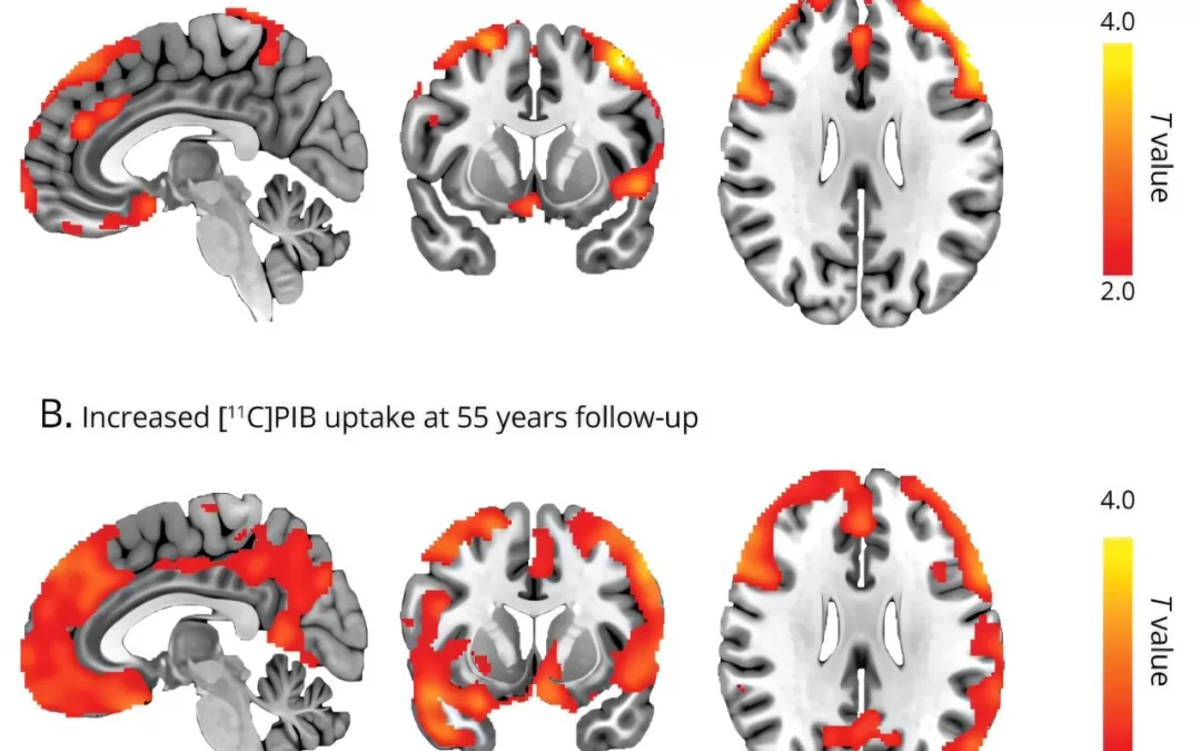 Childhood Epilepsy May Increase Risk of Alzheimer’s Later in Life