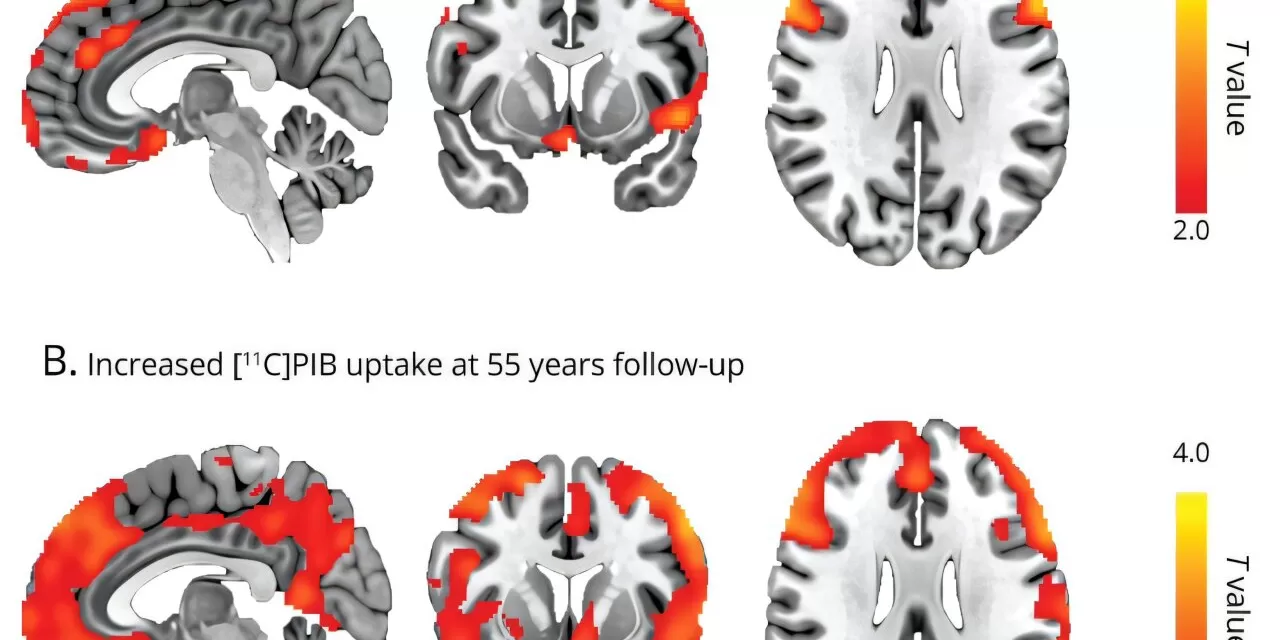 Childhood Epilepsy May Increase Risk of Alzheimer’s Later in Life