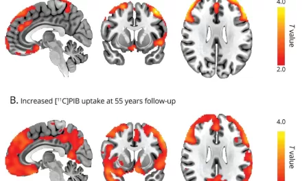 Childhood Epilepsy May Increase Risk of Alzheimer’s Later in Life