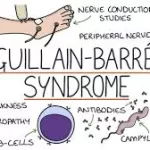 Surge in Guillain-Barre Syndrome Cases in Pune: 67 Affected, Rapid Response Team Activated