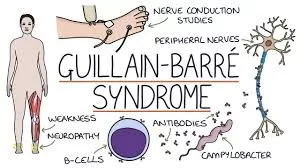 Mumbai Reports Suspected Guillain-Barré Syndrome (GBS) Case