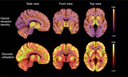 Elevated Opioid Neurotransmitter Activity in the Brain Linked to Anorexia, Study Reveals