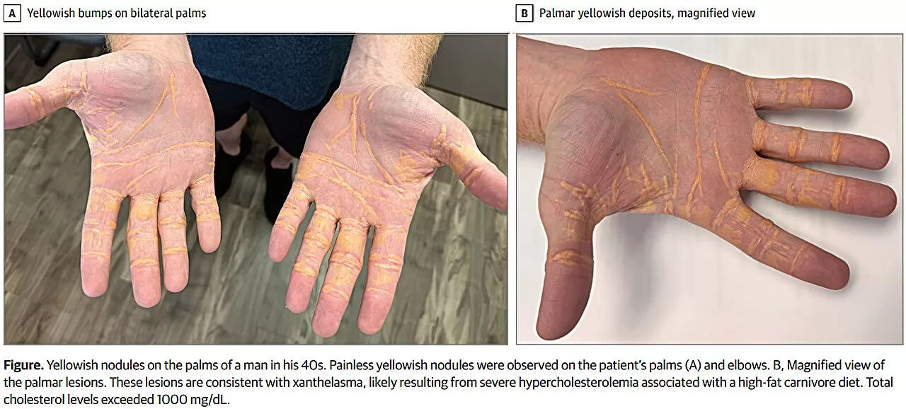 Man on Carnivore Diet Develops Yellowish Nodules on Hands, Feet, and Elbows