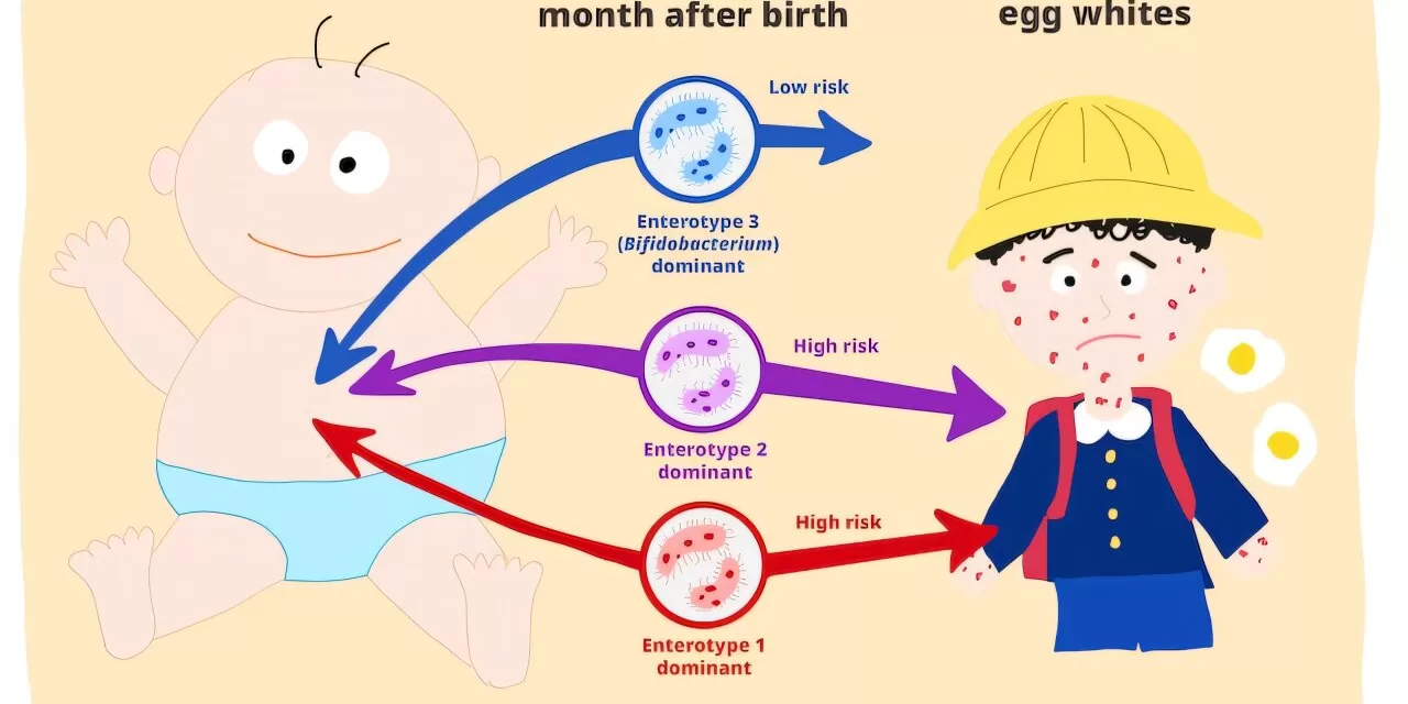 Infant Gut Bacteria Linked to Food Allergy Development