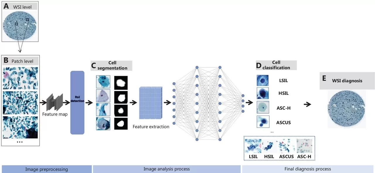 AI Can Enhance Cervical Cancer Detection with Medical Image Recognition