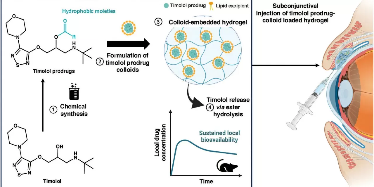 New Drug Delivery Method Promises Long-Lasting Glaucoma Relief