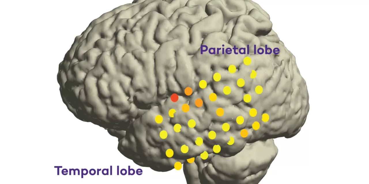 A Step Towards Aphasia Treatment: Study Maps New Brain Regions Behind Intended Speech