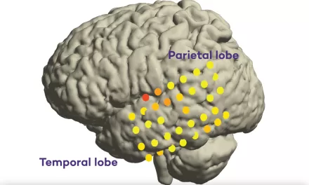 A Step Towards Aphasia Treatment: Study Maps New Brain Regions Behind Intended Speech