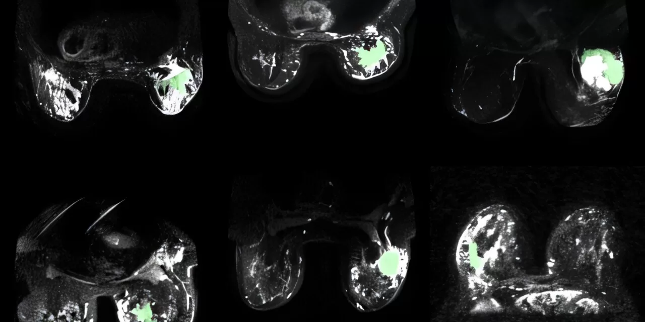 AI-Enhanced MRI Technology Makes Cancerous Breast Tissue Glow, Improving Detection and Treatment