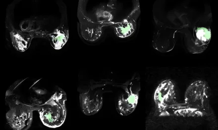 AI-Enhanced MRI Technology Makes Cancerous Breast Tissue Glow, Improving Detection and Treatment