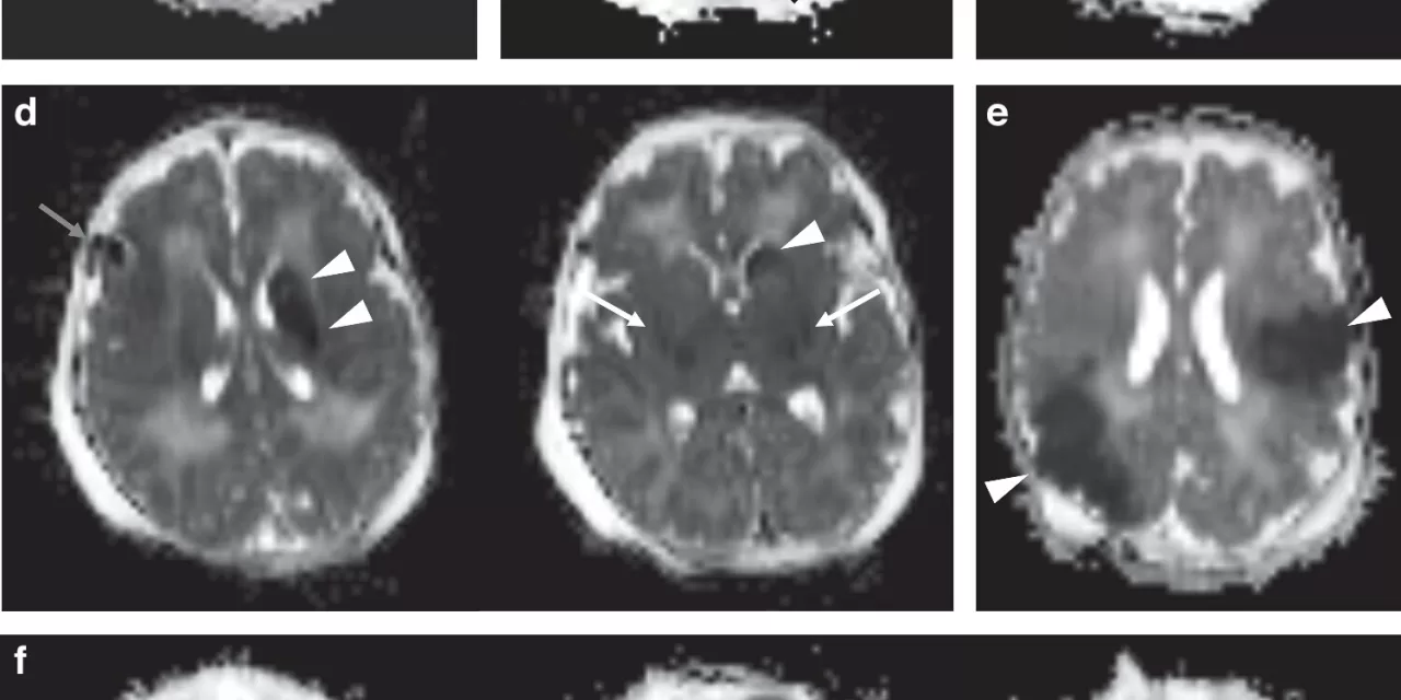 MRI Study Reveals Overlap Between Two Common Neonatal Brain Injuries