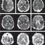 MRI Study Reveals Overlap Between Two Common Neonatal Brain Injuries