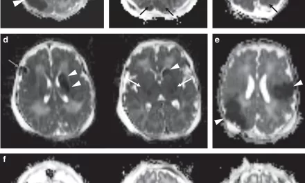 MRI Study Reveals Overlap Between Two Common Neonatal Brain Injuries