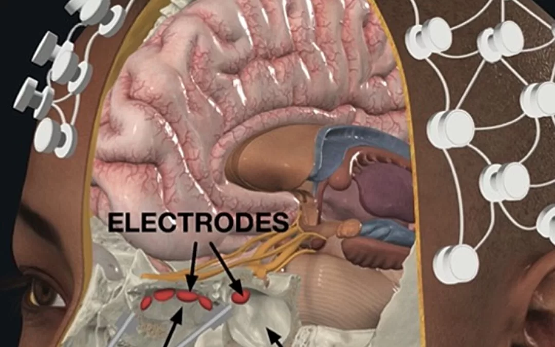 DeepFocus: A Breakthrough in Minimally Invasive Brain Stimulation