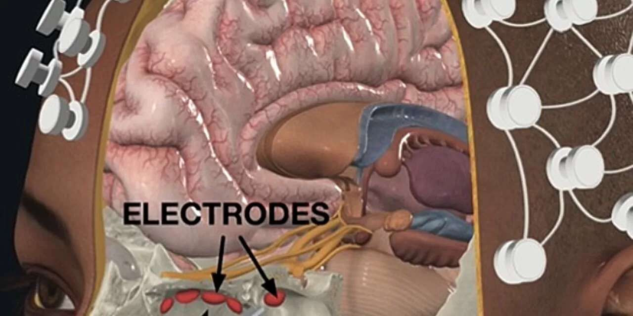 DeepFocus: A Breakthrough in Minimally Invasive Brain Stimulation