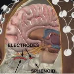 DeepFocus: A Breakthrough in Minimally Invasive Brain Stimulation