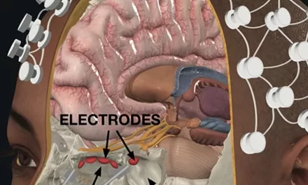 DeepFocus: A Breakthrough in Minimally Invasive Brain Stimulation