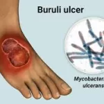 Updated Guidelines for Treating Buruli Ulcers Released