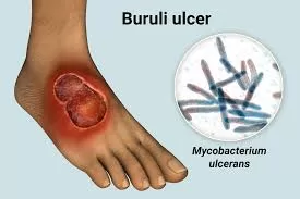 Updated Guidelines for Treating Buruli Ulcers Released