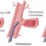 Magnetic Microrobots Successfully Remove Blood Clots from Sheep Iliac Artery