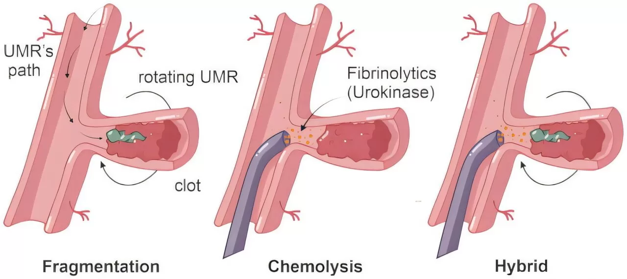 Magnetic Microrobots Successfully Remove Blood Clots from Sheep Iliac Artery