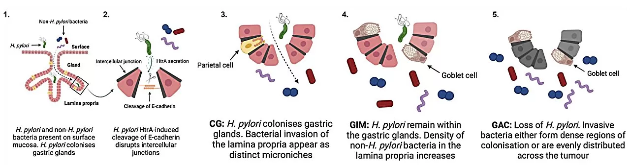 Bacteria ‘Leaking Across Stomach Lining’ Could Indicate Risk of Gastric Cancer, Study Finds