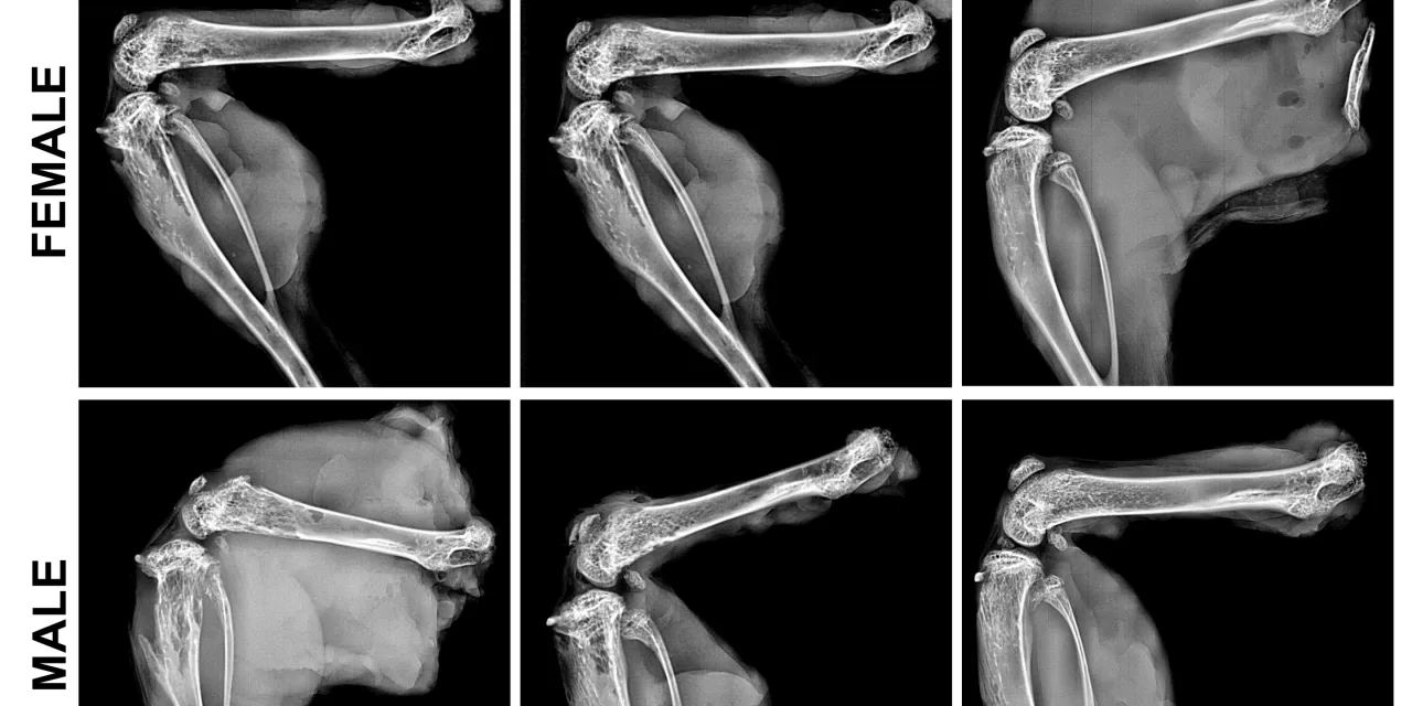 Gene Therapy Could Be ‘One-Shot Stop’ for Rare Bone Disease Hypophosphatasia, Research Shows