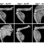 Gene Therapy Could Be ‘One-Shot Stop’ for Rare Bone Disease Hypophosphatasia, Research Shows