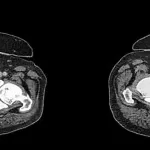 AI-Powered AbdomenAtlas: A Game Changer in Early Cancer Detection and Medical Imaging