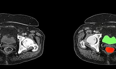 AI-Powered AbdomenAtlas: A Game Changer in Early Cancer Detection and Medical Imaging